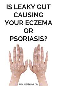 Is Leaky Gut Causing Your Eczema Or Psoriasis Psoriasis Cure Skin Problems Psoriasis Psoriasis Remedies