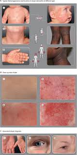 Image result for Atopic eczema atopic dermatitis