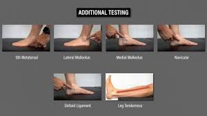 Image result for Ankle External Rotation Test