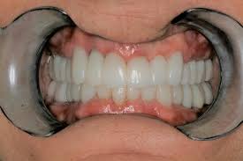 It depends on how severe it is! Overbite Correction Without Surgery Konig Center For Cosmetic Comprehensive Dentistry