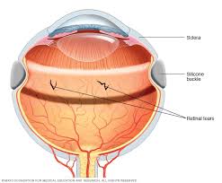 Therefore, in general, no treatment is needed for lattice degeneration aside from regular monitoring with dilated fundus examinations. Retinal Diseases Diagnosis And Treatment Mayo Clinic