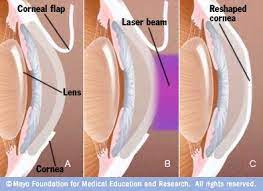 Lasik Surgery Lasik Eye Surgery Eye Surgery Lasik Surgery