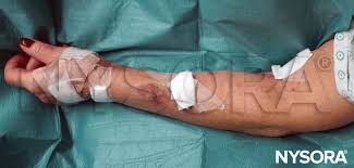 Image result for Peripheral IV Access