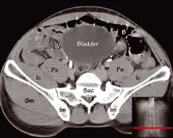 This is the iliopubic line which outlines the anatomic anterior column this is the. Abdominal Ct Anatomy Radiology Key