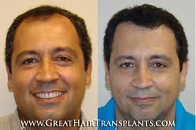 Female Hair Loss Treatment & Restoration in Virginia Wise Mintons Store