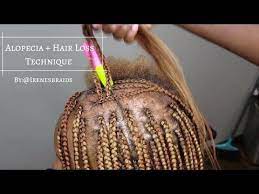 New Technique Alopecia Hair Loss Box Braids Irenesbraids Youtube Alopecia Hairstyles Hair Loss Alopecia Braids For Thin Hair