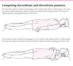Decerebrate Vs Decorticate Postures How I Remember Decerebrate Extremeties Are Facing Outdecorticate Ext Nursing Study Guide Acute Nursing Medical Knowledge