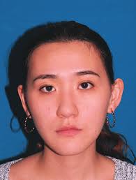 Class III Malocclusion with an Atrophic Edentulous Ridge Treated with  Autotransplantation, Lower First Molar Extraction and Spac