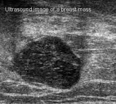 Breast ultrasound is not usually done to screen for breast cancer. Ultrasound For Breast Cancer Screening Moose And Doc