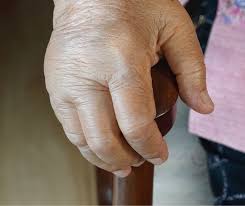 Image result for Dactylitis