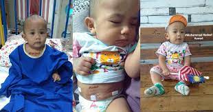 Bila anak demam on off lebih 3 hari, sesuatu mesti dilakukan. Demam On Off Kerana Sakit Hernia Selepas 8 Bulan Melaluinya Hadeef Kembali Sihat Pa Ma