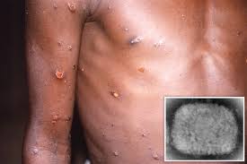 US: 2 children diagnosed with monkeypox | News | DW