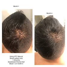 Check out 17 of the best fixes and remedies for hair loss. Hair Loss Solutions Moda Hair Design