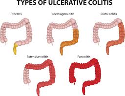 Some insurance plans also consider a colonoscopy diagnostic if something is found (like a polyp) during the procedure that needs to be removed or biopsied. Colonoscopy Cost Health Hearty
