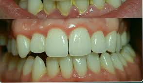 How do you know what to eat or what not to eat? How To Get Rid Off Tartar And Plaque Istanbul Dental Care