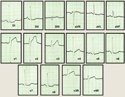 La miocardiopatía hipertrófica es principalmente una enfermedad del músculo cardíaco caracterizada por el aumento del grosor de sus paredes debida a. Miocardiopatia Hipertrofica Debut Con Insuficiencia Cardiaca Presentacion De Un Caso Clinico Revista Electronica De Portales Medicos Com
