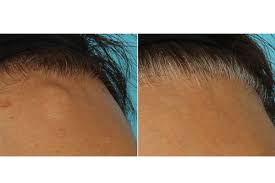 We may earn commission from links on this page, but we only recommend products we back. Osteoma Removal Chicago Il