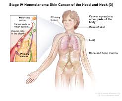These usually begin in lymph nodes, but they can also affect the bone marrow. Skin Cancer Types Symptoms Information Dana Farber Cancer Institute Boston Ma