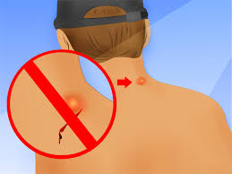 Das Erneute Auftreten Von Furunkeln Verhindern Wikihow