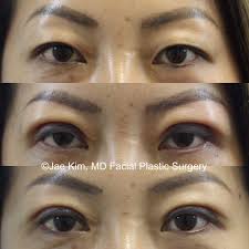 Back back to photo gallery. Is Asian Double Eyelid Surgery Right For Me Jae Kim Md