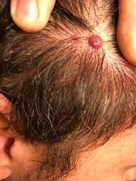 Though, a cherry angioma on scalp is rare and often asymptomatic, they can lead to massive bleeding if injured. Is This Just A Large Cherry Angioma Dermatologyquestions