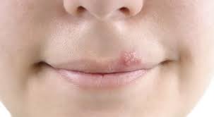 Como Combatir El Herpes Labial Bezzia