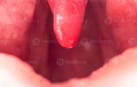Image result for Uvulitis
