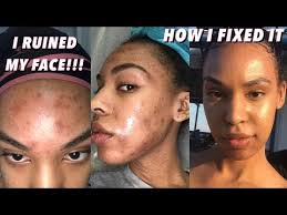 How I Ruined My Skin Chemical Burn Hyperpignmentation Face Peel And How I Cleared It You Chemical Burn Face Peel Hyperpigmentation Black Skin Treatment