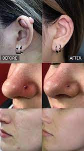 Jan 16, 2014 · hypertrophic nose piercing scars heal by themselves after some time unlike keloids which tends to be more permanent. Keloid Scar Removal