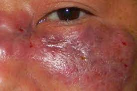 Puede haber manchas negras en la piel. Que Es El Hongo Negro La Infeccion Letal Que Aumenta Entre Pacientes Con Covid 19 En La India Eleconomista Es