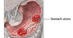 Xiphoid Process Pain: Relieve Chest Pain With Xiphoid Process Relief!