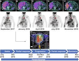 Treating with immunotherapy uses certain parts of a person's immune system to fight cancer. Abscopal Effect In A Patient With Malignant Pleural Mesothelioma Treated With Palliative Radiotherapy And Pembrolizumab Clinical And Translational Radiation Oncology
