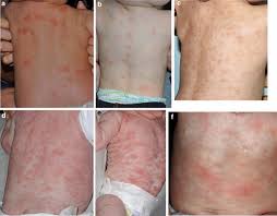 Image result for Urticaria pigmentosa children