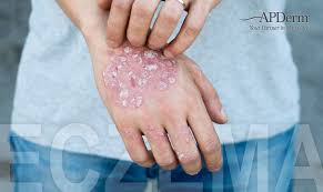 Image result for Atopic eczema atopic dermatitis