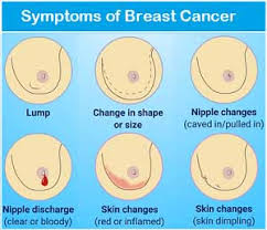 Early signs a new mass or lump in breast tissue is the most common sign of breast cancer. Breast Cancer Causes Symptoms Signs Stages Treatment Awareness Imdip Imdip India S First Website On Pharmacy