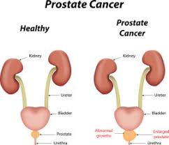 However, if a steady rise is identified, this indicates either the cancer has recurred in the area where the. Prostate Cancer Healthy Inside