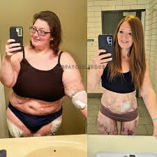 Image result for Calciphylaxis