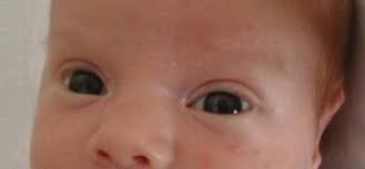 Medical conditions that cause the nasal bridge not to develop and project are also associated with epicanthic fold. The Neonate With Minor Dysmorphisms Intechopen