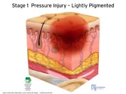 pressure ulcers physiopedia