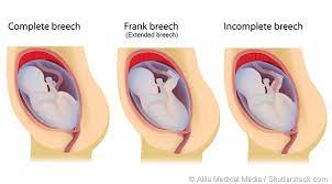 Extended Breech Flexed Breech And Footling Breech