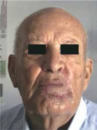 Lower lip reconstruction using a skin-mucosa Abbe-Estlander flap after  squamous cell carcinoma excision*