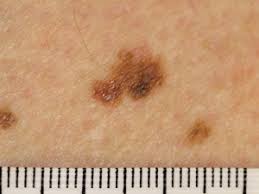 By the time melanoma of the foot or ankle is diagnosed, it frequently has progressed to an advanced stage, accounting for a higher mortality rate. Detecting Malignant Melanoma Bpj34