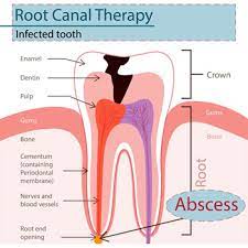 Then there are some dental policies that cover basic dental services such as biannual. Root Canal Treatment Options Procedures Costs