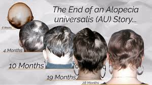Diseases related to alopecia universalis congenita via text searches within malacards or drugs for alopecia universalis congenita (from drugbank, hmdb, dgidb, pharmgkb, iuphar, novoseek. The End Of An Alopecia Universalis Au Story Beginning Of A New Hair Regrowth Journey Youtube