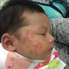 Contact ubat ekzema terbaik on messenger. 5 Months Of Agony Severe Eczema Cerita Eczema Aryan