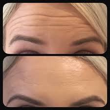 Botox for forehead the before and after results of botox makes it pretty clear that units of botox play a major role in transforming your face shape. Botox Treatments Wrinkle Treatments With Botulinum Toxin Renew Appearance Medicine Mobile Cosmetic Medicine Clinic