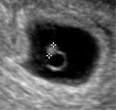 Fausse couche | aliments qui peuvent causer des fausses couches en début de grossesse. Echographie Obstetricale