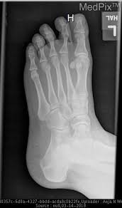 The metatarsals were the most common bone type involved with the third metatarsal a mean rehabilitation time for single metatarsal fractures was found to be 12.2 weeks, which still being a period of rest from training sufficiently long enough so as to allow healing to occur. Medpix Case Fracture Of Left 3rd 4th And 5th Metatarsals