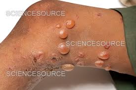 Image result for Pemphigus