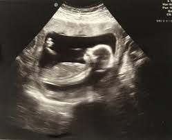 Ultraschallgerät schwangerschaft für zuhause 💜 selektion toller modelle! Schwangerschaft Die Ersten 3 Monate Die Kleine Botin